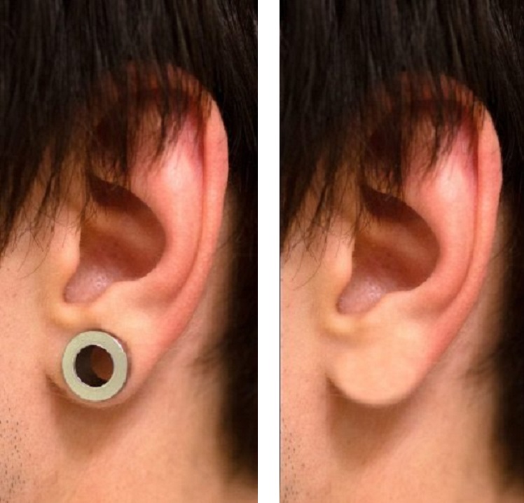 Loboplastia caso 1 — antes y después